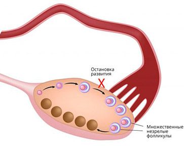 anormal-ovary-1